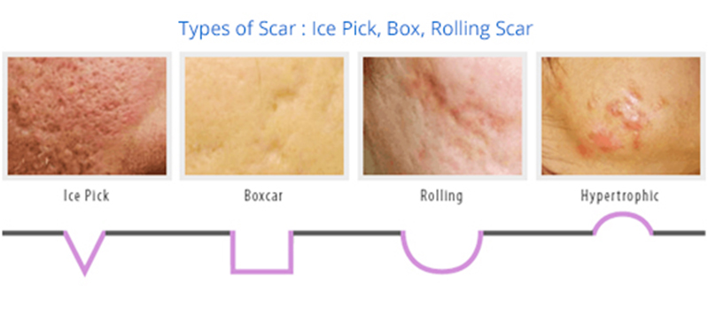 types of scar(ice pick,box)